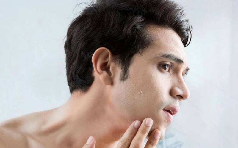 Da dầu có nhiều bã nhờn trên bề mặt da.